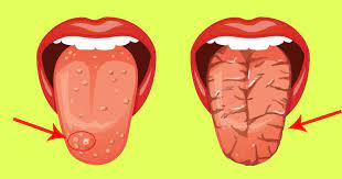 7 Changes In Your Tongue That Are Warning Signs White Sore On Tongue Burning Tongue Syndrome Tongue Sores Causes