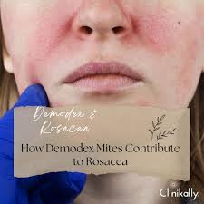 Image result for demodex rosacea