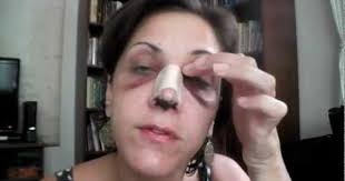 Day 3 Rhinoplasty Patient Diary The Patient S Recovery Process Has Gone Far Better Than Her Expectations She Rhinoplasty Acne On Nose Rhinoplasty Recovery