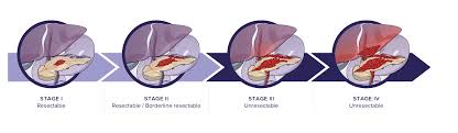 Some risk factors such as age, gender, race, and family history can't be controlled. The Stages Of Pancreatic Cancer Immunovia