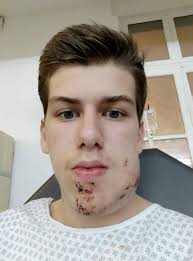 ⚫16 ANS, GJ. DOUBLE FRACTURE DE LA MÂCHOIRE ⚫ Hier à Lyon, un jeune  manifestant de 16 ans a reçu un tir de LBD au visage ! Il a été hospitalisé  d'urgence