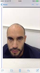 Adam Ullah after 6 months growth. FUE hair transplant. Call 014410860 for a  consultation.