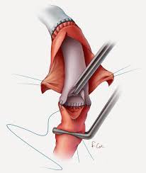 Ascending Aortic Aneurysm Completed Elephant Trunk Procedure Medical Illustration Medical Aortic Aneurysm