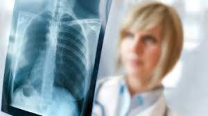 Lung cancer signs and symptoms. Readers Den Health