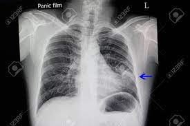 The chest radiograph reveals a left lower lobe opacity with pleural effusion. A Chest X Ray Of A Patient With Pneumonia With Left Lower Lung Infiltration Stock Photo Picture And Royalty Free Image Image 96411994