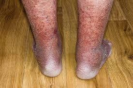 Image result for Pigment stains on the shin