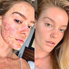 Tiworld™ PoreClear 2% Omi isọdọtun awọ ara BHA