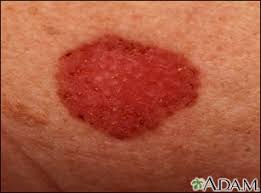 Bcc is also known as rodent ulcer and basalioma. Skin Cancer Basal Cell Carcinoma Spreading Medlineplus Medical Encyclopedia Image