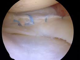 He never told me whether he repaired the meniscus or i have been suffering with a swollen knee for three months after arthroscopic knee surgery a year prior. Can A Meniscus Tear Heal Howard J Luks Md