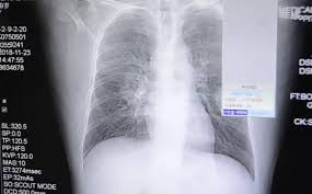 Jenis jangkitan paling utama di saluran pernafasan adalah penyakit pneumonia. Hidu Stokin Busuk Jadi Punca Lelaki Ini Alami Jangkitan Kulat Pada Paru Paru
