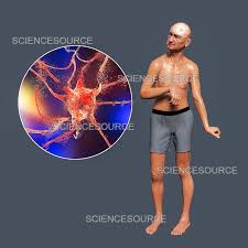 Image result for Chorea