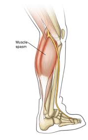 There are over 650 muscles in the human body. Muscle Spasm