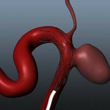Tensión geopática, miasma crónico, origen genético, desequilibrio psíquico, toxicomanía, reacción alérgica, tumores, aneurisma, toxemias, virus. Aneurisma Cerebral Home Facebook