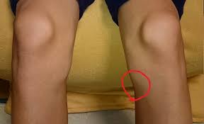 膝の痛み 曲げると痛い 内側側副靱帯損傷