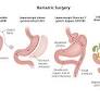 bariatric surgery from www.gleneagles.com.sg