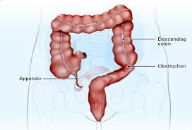 It measures about 4 inches long. Appendicitis Symptoms Signs Causes Appendectomy In Detail