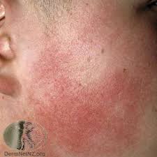 Image result for Keratosis pilaris