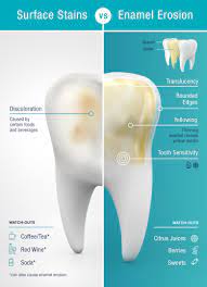 Excessive strong coffee and cola drink consumption, along with smoking, will give your teeth unsightly brown stains. Stained Teeth Or Enamel Erosion Pronamel Toothpaste