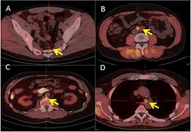 Check spelling or type a new query. Pet Ct Scan Whole Body Cpt Code Ct Scan Machine