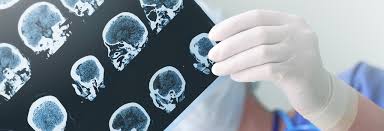 Elle est caractérisée par des troubles de la mémoire récente, des fonctions exécutives et de l'orientation dans le temps et l'espace. Maladie D Alzheimer Un Lent Declin Science Vie