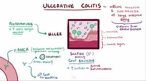 Image result for Ulcerative Colitis