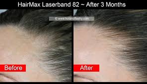 Here's our review and guide to the best laser combs and systems 2021. Hairmax Laserband Hair Regrowth 3 Month Update Hotandflashy Com