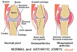 Image result for rheumatoid arthritis pictures