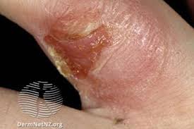 Image result for sores on the head in children