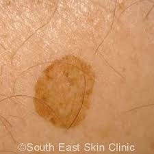 Image result for liver spots on legs