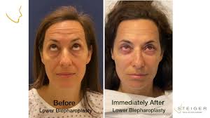 Lower Eyelid Surgery
