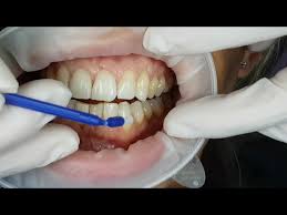 Instruct the patient to allow varnish to remain in contact with the tooth surfaces for a minimum of 4 hours. Fluoride Varnish Application Youtube