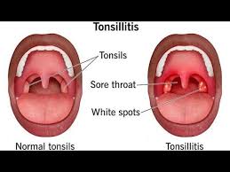 Image result for Tonsillitis