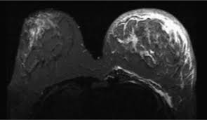 In its early stages, breast cancer usually does not cause pain and may exhibit no noticeable symptoms. Inflammatory Breast Cancer An Overview Sciencedirect