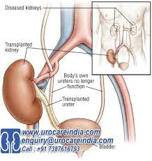 Kidney Transplant Surgery India At Low Cost Kidney Transplant Cost Kidney Transplant Kidney Transplant