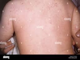 Image result for dermatitis contacta children