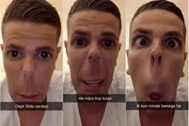 Kempenaar vertelt op hilarische wijze hoe hij met zijn hoofd vastraakte  tussen liftdeuren: “Ineens van een gewoon hoofd naar dit hoofd”