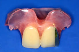 See more of gigi palsu on facebook. Gigi Palsu Dental 55 Bandung