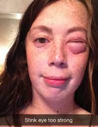 27 Allergic Reactions That Are So Bad They Ll Actually Make Your Face Hurt Allergic Reaction On Face Eye Allergic Reaction Rash Allergic Reaction