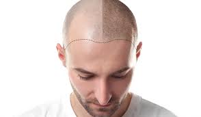 Um zu klären, warum die haare nach einer haartransplantation wieder ausfallen, müssen wir generell näher auf den haarausfall und die vielmehr sind einige haare aktuell in der ruhephase oder wachsen nach, während andere ausfallen. 10 Dinge Die Sie Uber Haartransplantationen Wissen Sollten Beautyista De