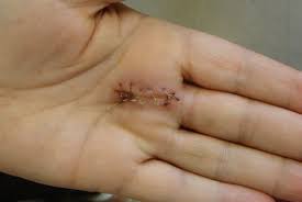 We did not find results for: Treatments For Trigger Finger Gponline