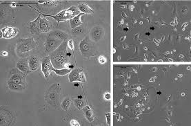 The cytologic features of mesothelioma and other examination . Frontiers A Ticket To Ride The Implications Of Direct Intercellular Communication Via Tunneling Nanotubes In Peritoneal And Other Invasive Malignancies Oncology