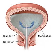 If nobody smoked, one of every three cancer deaths in the united states. Treating Bladder Cancer Intravesical Therapy Saint Luke S Health System