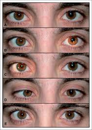 Image result for Mydriasis
