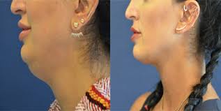 You need to be patient with kybella but it works.good luck! Kybella Vs Coolmini Which Would You Choose Coolmini Forum