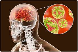 In these cases, symptoms may include headache, vomiting, fever, confusion and seizures. Cual Es Encefalitis Japonesa