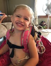 Experiences with g tube switched to g/j tube?