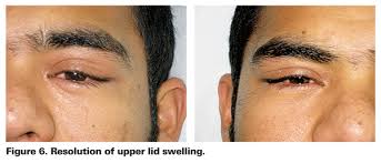 Image result for Dacryoadenitis