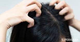 5 أسباب لحكة فروة الرأس وعلاجها سوبر ماما