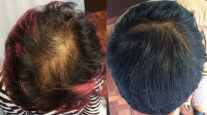 Male androgenetic alopecia (male pattern baldness) androgenetic alopecia. Stem Cell For Hair Loss Dr Ben Behnam Md Faad Best Dermatologist Los Angeles