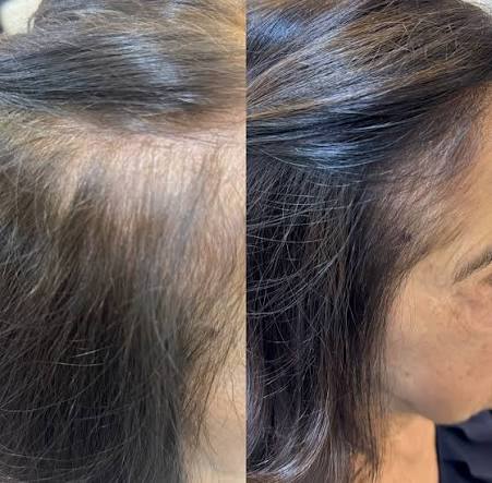 🌿 Evolução visível Na imagem, apresentamos o antes e depois de um  protocolo de terapia capilar focado em estimular o crescimento saudável dos  fios. O processo envolve equilíbrio do couro cabeludo, ativação